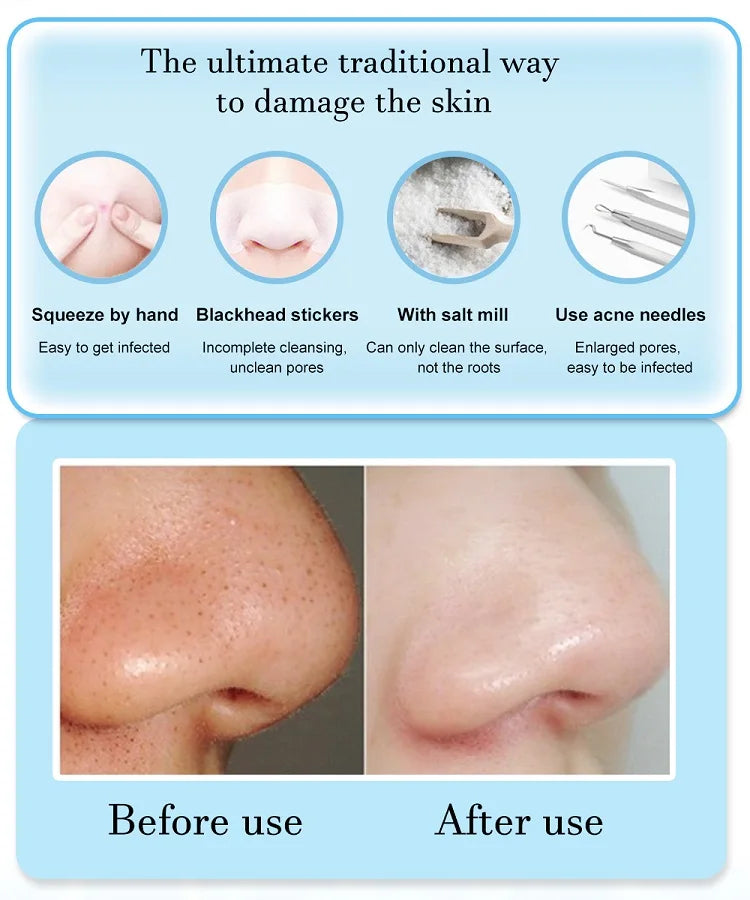 Cleansing Beauty Machine Dead Skin Remover Face Vacuum Blackhead Removal Skin